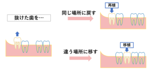 目黒区・目黒本町・碑文谷で、「歯を残したい」「歯が折れた」等でお困りの方は碑文谷コート歯科までご相談ください。